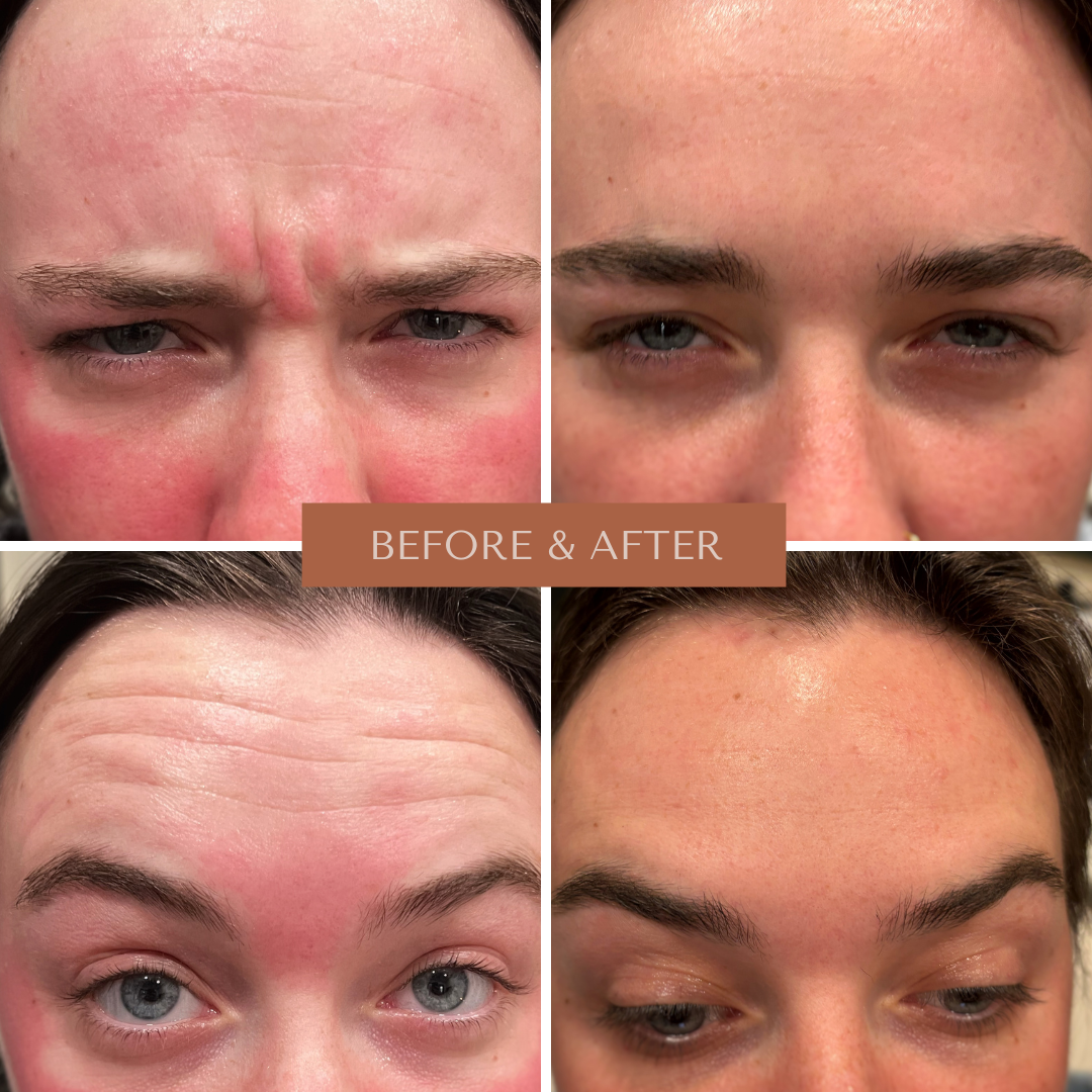 Xeomin Before & After